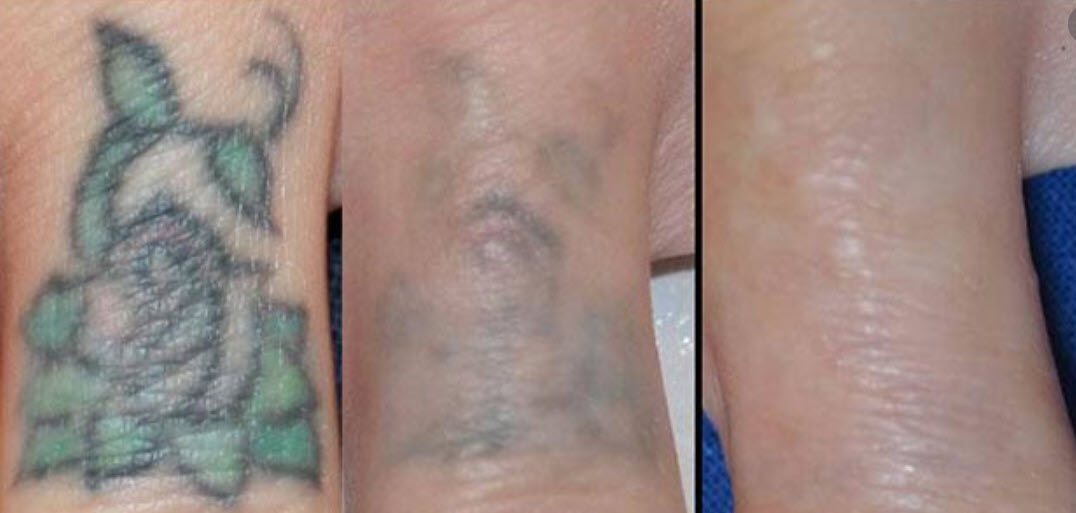 Eliminación de tatuaje con láser